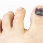 Descubre por qué duelen las uñas de los pies: causas y soluciones